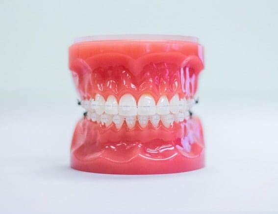 clear braces