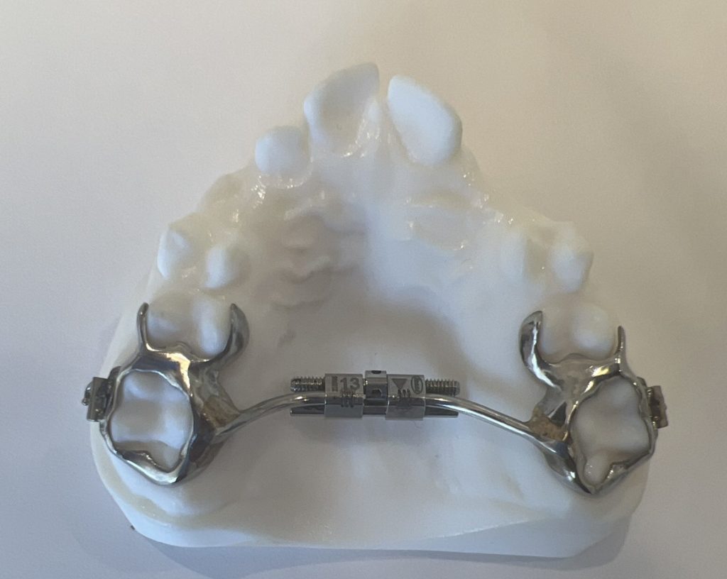 Everything You Need to Know About Palatal Expanders | Wedding Thompson