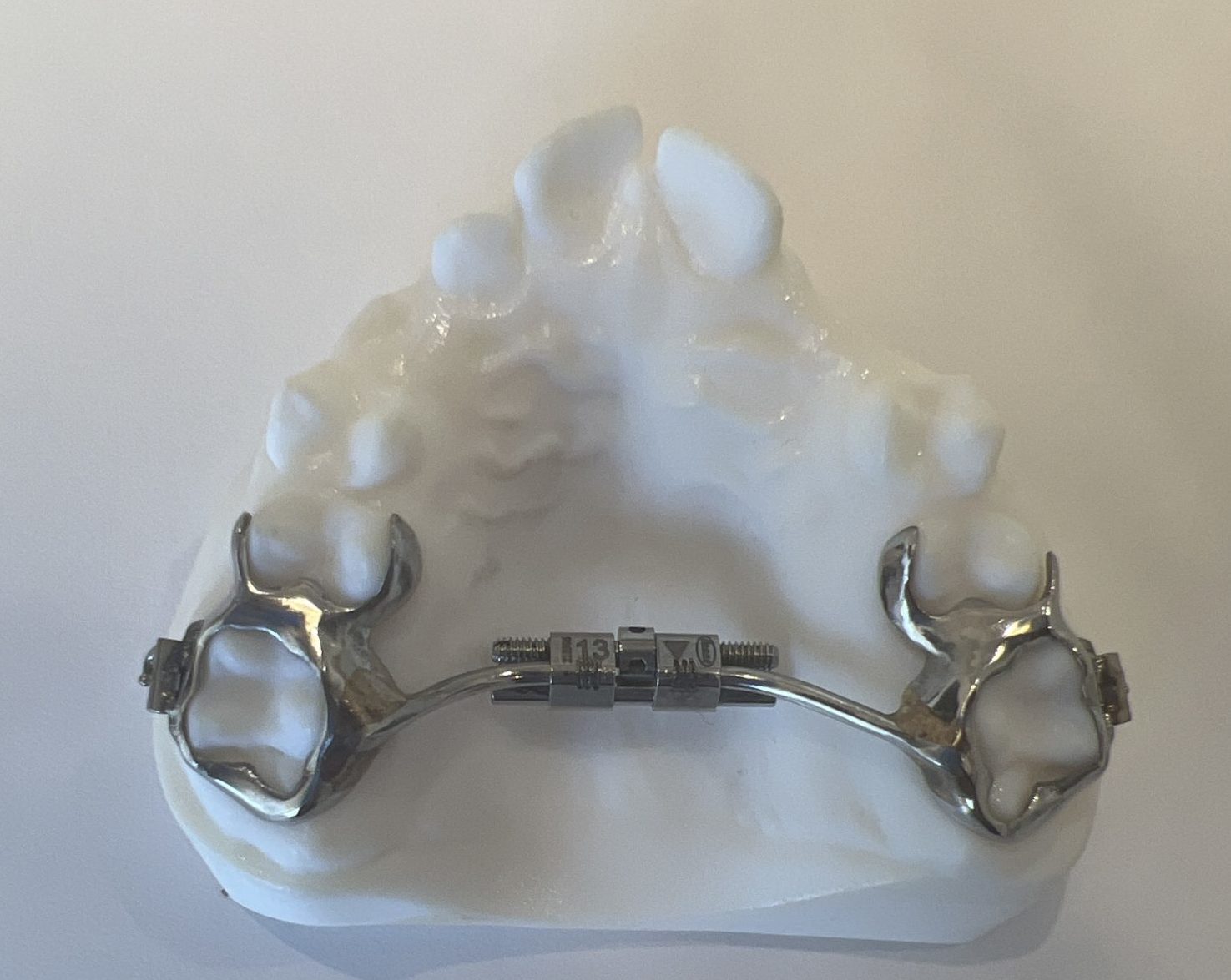 Everything You Need to Know About Palatal Expanders